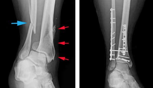 Nonunion Fracture