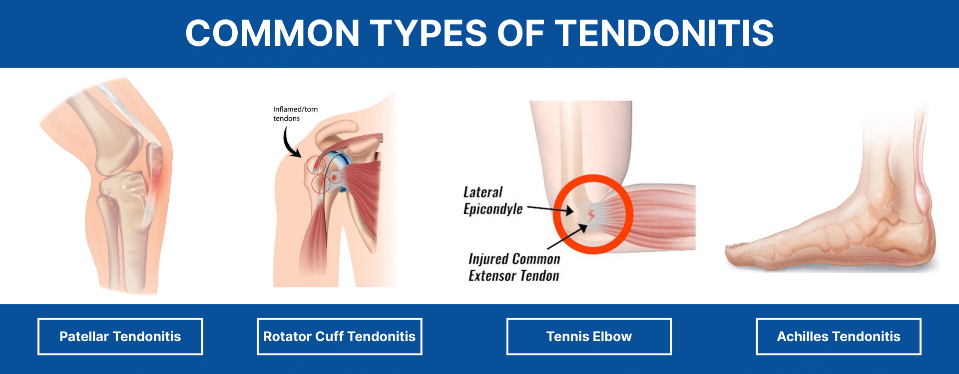 Common Types of Tendonitis