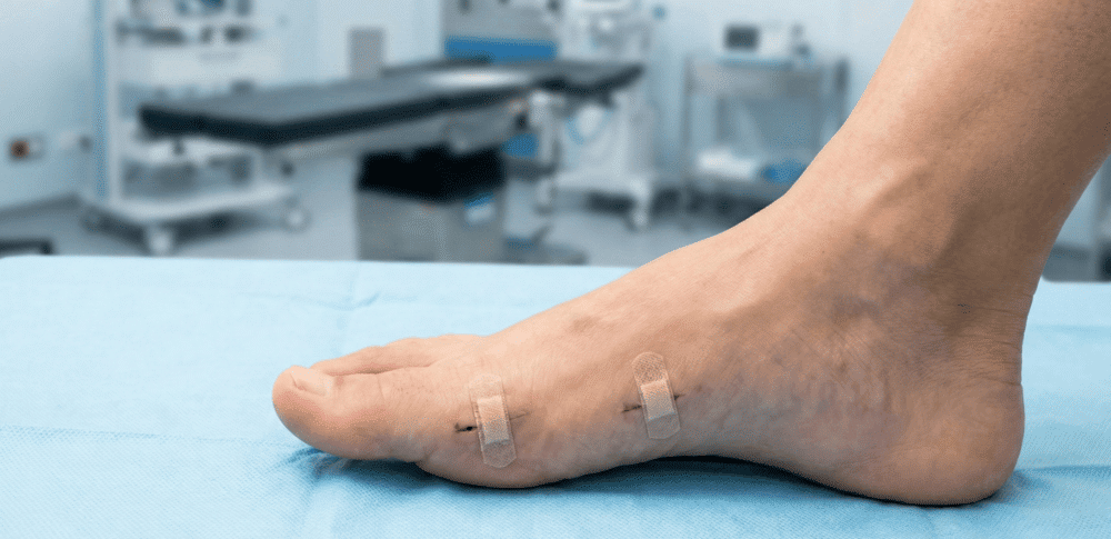 Advancements in Minimally Invasive Foot Surgery