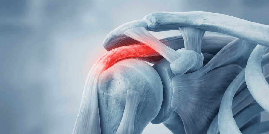 Understanding Shoulder Impingement Syndrome