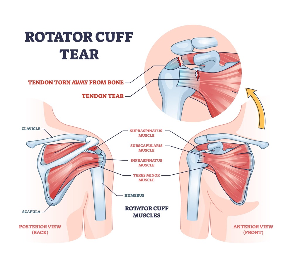 What Is a Rotator Cuff Tear and When Does It Need Surgery